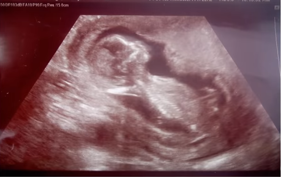 Ultrasound of a fetus in the womb, Photo Credit: Viral Stories/Youtube
