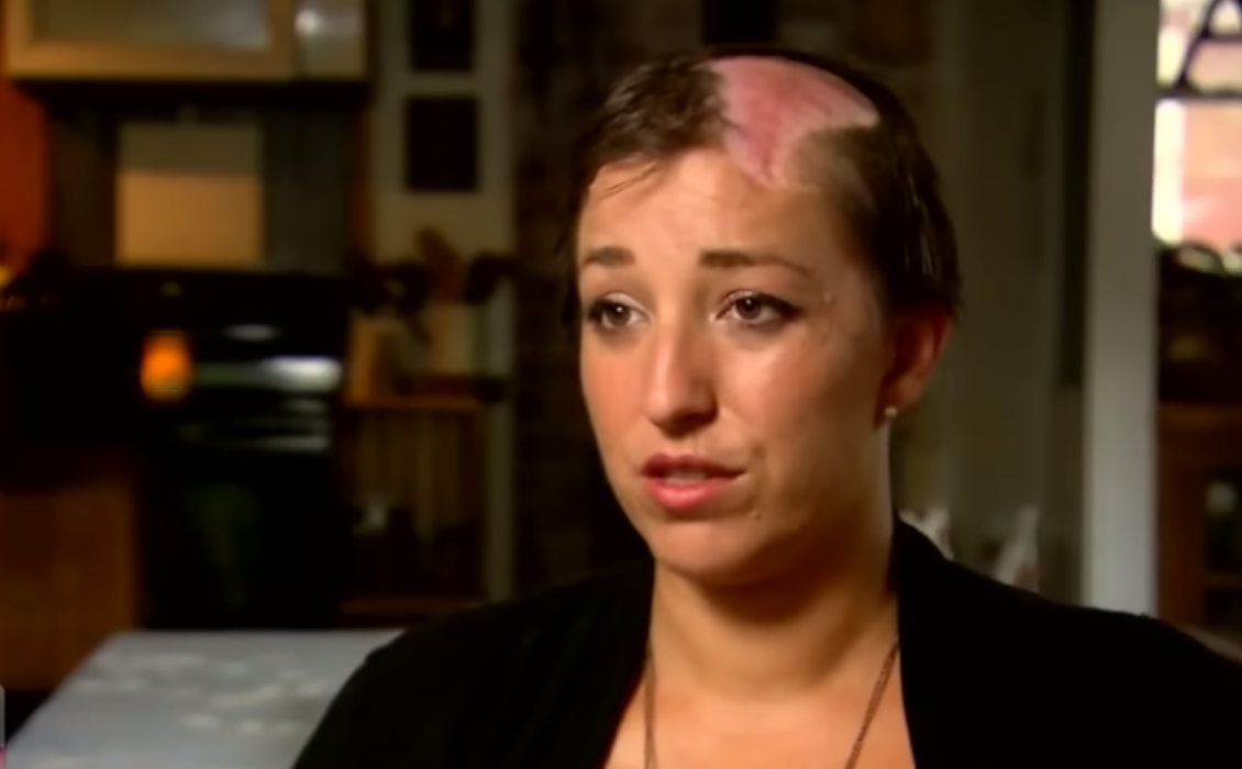 Alon Abare without her wig showing the burned area of her scalp from the accident,�Photo Credit: Inside Edition/Youtube