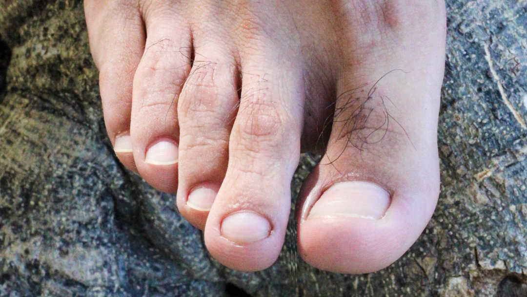 Have You Noticed Hair on Your Toes? Doctor Explains What It Could Mean