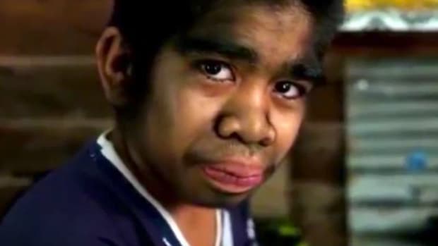Teen Revered, Mocked For Werewolf Syndrome (Video) Promo Image