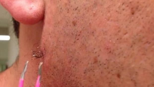 Here's What Happens When You Extract A Months-Old Ingrown Hair (Video) Promo Image