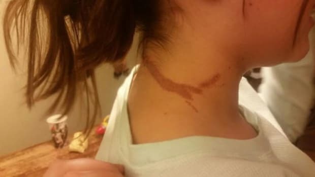 13-Year-Old Girl Sustains Serious Burns From Cell Phone Promo Image