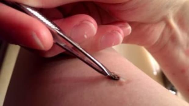 Here's What This Woman Pulled Out Of Her Leg (Video) Promo Image