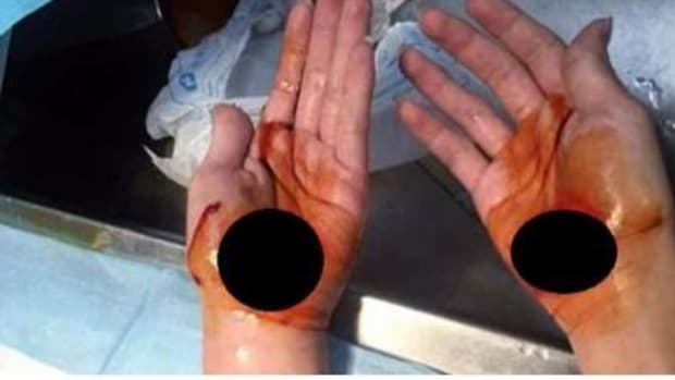 Parents Outraged After Child Comes Home With Hands Looking Like This (Photos) Promo Image