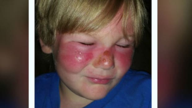 Mom: Boy Got Burns While Wearing Sunscreen (Photos) Promo Image