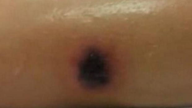 10-Year-Old Suddenly Dies After Discovering Mysterious Mark On Leg (Photo) Promo Image