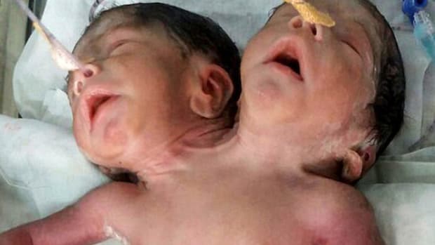 Baby Born In India With Two Heads (Photos) Promo Image