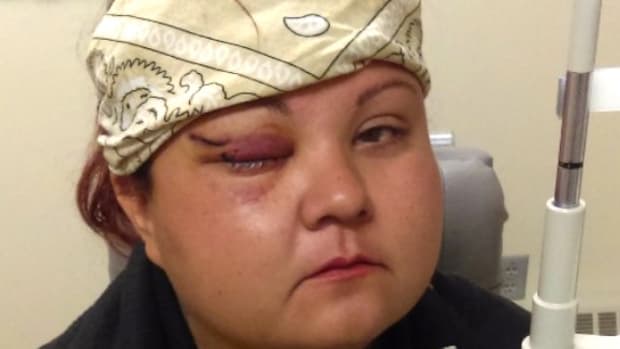 DAPL Protester Suffers Eye Injury, May Lose Vision (Video) Promo Image