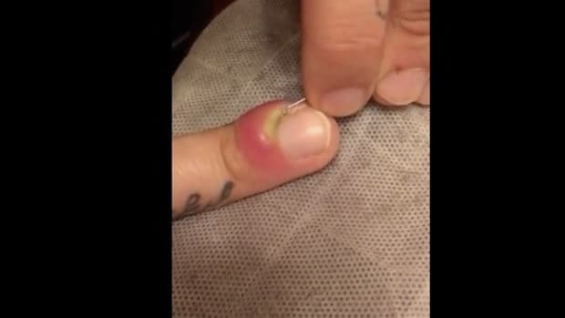 Man Pops Swollen Finger With Horrifying Results (Video) Promo Image