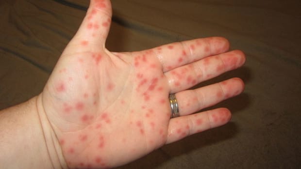 Public Warned Of Hand, Foot And Mouth Disease Outbreaks Promo Image