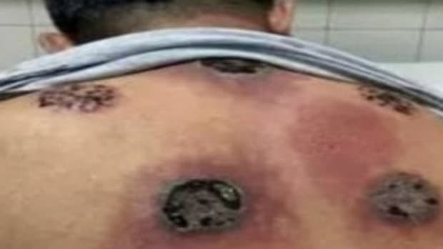 cupping therapy opposing views