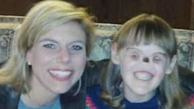 Girl Born Without Eyes And Nose Gets Surgery (Photos)  Promo Image