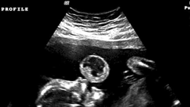 Woman Thinks Her Baby Is Blowing Bubble In Ultrasound, Then Doctors Reveal What It Really Is Promo Image