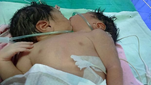 Photo Of Conjoined Twins Kissing Goes Viral (Photos) Promo Image