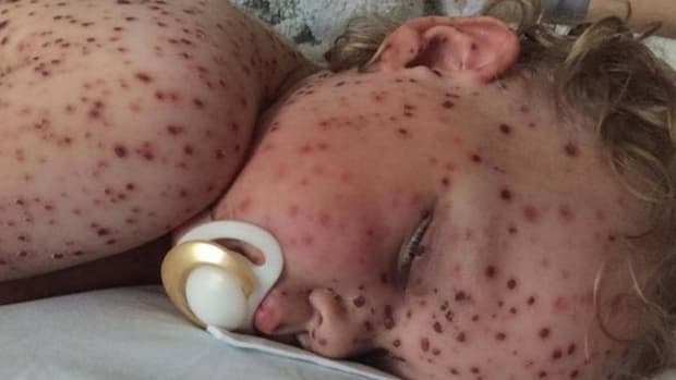Toddler Has 'Worst Ever Case Of Chickenpox' (Photos) Promo Image