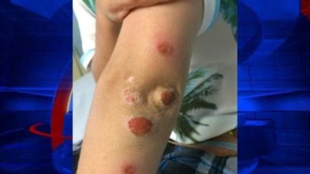 Mother Issues Warning To Other Parents After Discovering Cause Of Spots On 10-Year-Old's Body Promo Image