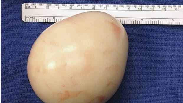 Man's Egg-Shaped Lump Makes Medical History (Photos/Video) Promo Image