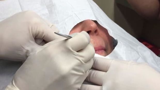 Woman Gets Bump Above Lip Squeezed, What Comes Out Leaves Dermatologist Shocked (Video) Promo Image