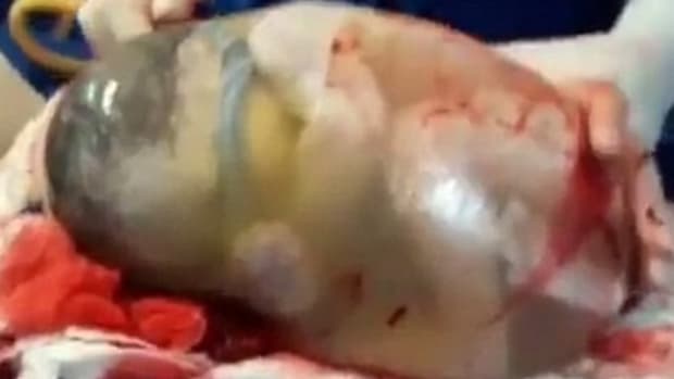 Baby Born Inside Fully-Intact Amniotic Sac (Video) Promo Image