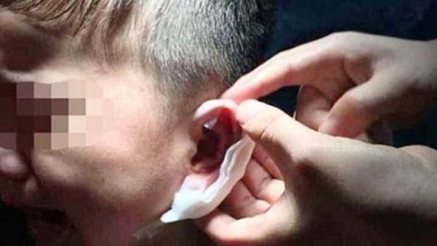 Parents Find Staples In 4-Year-Old Boy's Ear, Make Horrific Discovery (Photos) Promo Image