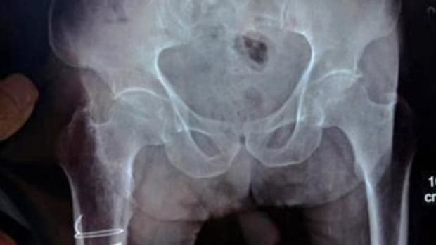 94-Year-Old Vet Complains Of Pain In Abdomen, Gets Surprising Diagnosis (Photos) Promo Image