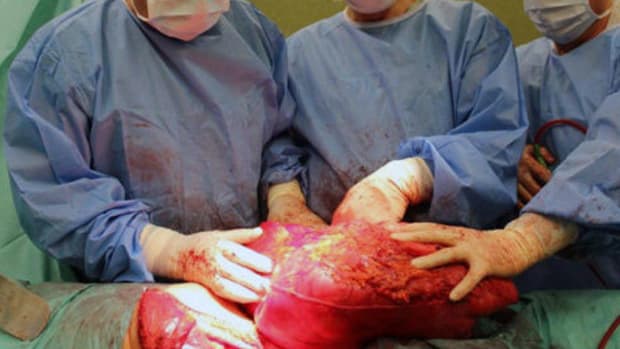 Man Mistook Cancerous Tumor For Beer Belly (Photos) Promo Image