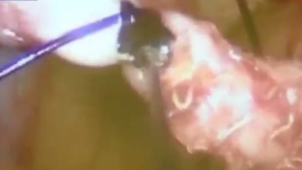 Doctors Find Worms Crawling In Teen's Appendix (Video) Promo Image