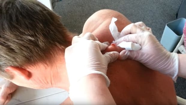 Man Has Giant 30-Year-Old Cyst Popped On His Back (Video) Promo Image