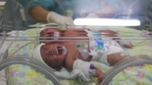 Indonesian Baby Born With Two Heads (Photos) Promo Image