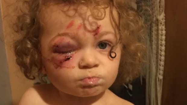 Toddler's Face Mauled By 'Super Mean' Pit Bull Promo Image