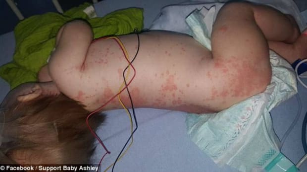 Mother Shares Photos Of Meningitis-Infected Baby (Photos) Promo Image
