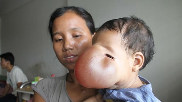 This Girl Has A Tumor Covering Half Her Face (Photos) Promo Image