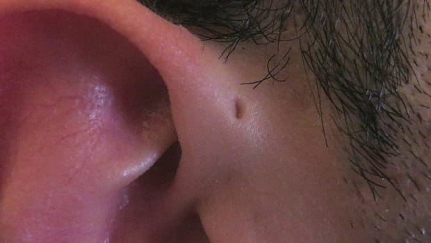 This Is Why Some People Have Holes In Their Upper Ears (Photo) Promo Image
