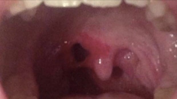 Doctors Find Woman With Hole Inside Her Throat, Horrified To Realize What Ex-Boyfriend Did (Photos) Promo Image