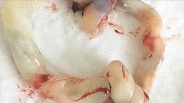 Doctors Cut Into Pregnant Woman For C-Section, Make Surprising Discovery (Photos) Promo Image