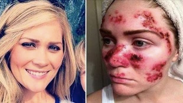 Woman Shares Disgusting Selfie To Help End Trend That Nearly Killed Her Promo Image