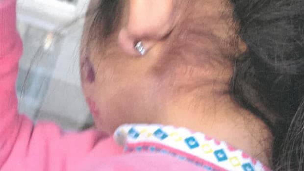 injury on Ana's 4-year-old daughter