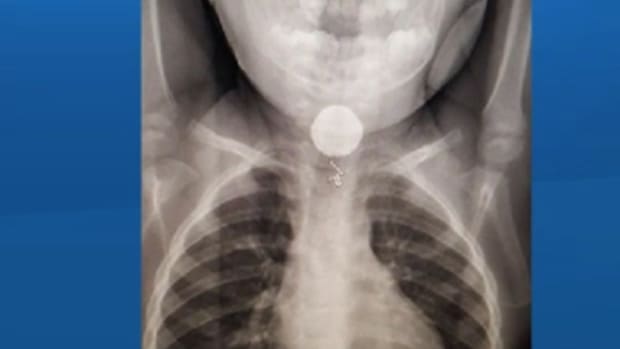 The X-ray Of A Button Battery Inside A Toddler