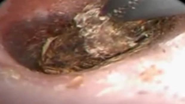 Centipede being pulled out of woman's ear