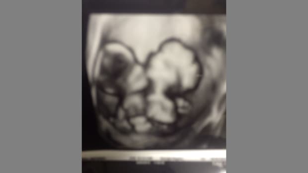 Conjoined Twins Sonogram.