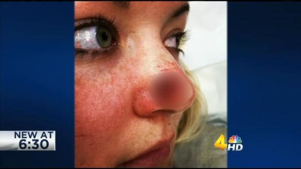 Nurse With Skin Cancer Used Tanning Beds (Photos) Promo Image