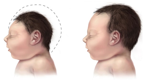 A child with microcephaly compared with healthy development