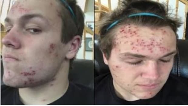 Teen Shocked To Discover How He Got Herpes, Demands The School Take Action Promo Image