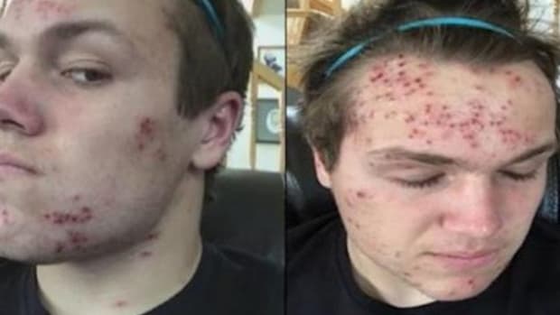 Teenager Shocked To Learn How He Got Herpes, Demands The School Take Action Promo Image