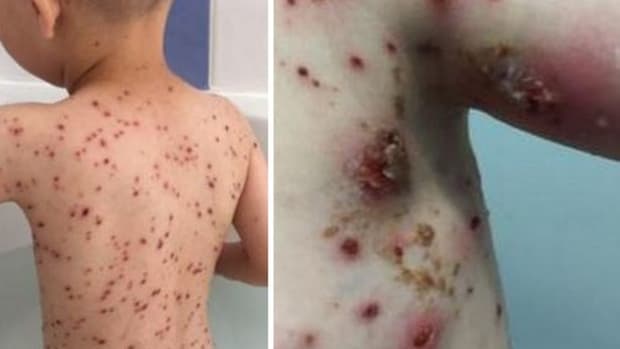 Chicken Pox Treatment Warning Wins Wide Audience Promo Image