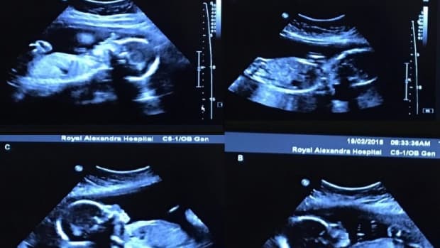 Canadian Couple Expecting Identical Quadruplets (Video)  Promo Image