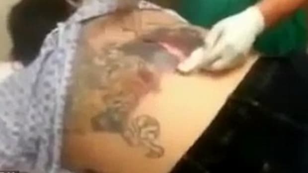 Graphic Video Shows What Happens When A Tattoo Gets Infected (Video) Promo Image
