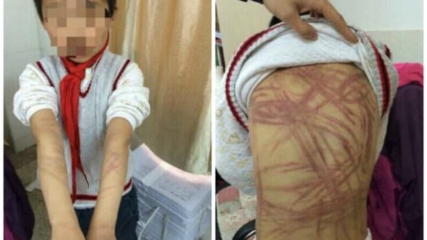 These photos of a 9-year-old boy's injuries went viral, and his adopted mother was sentenced to a 6-month prison term by a Chinese court for beating him with a back scratcher and jump rope.