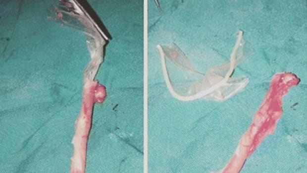Doctors Find Condom Inside Woman's Appendix (Photo) Promo Image