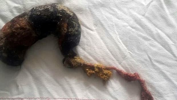 Massive Hairball Removed From Woman's Stomach (Photos) Promo Image